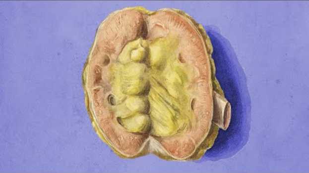 Video A Dad Drank A Snowglobe. This Is What Happened To His Kidneys. en español
