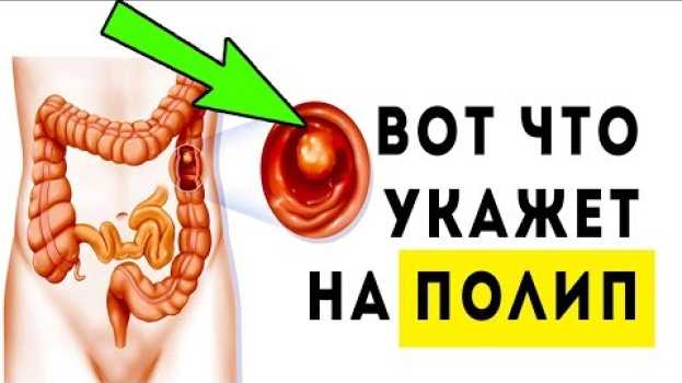 Video Это говорит о полипах и повреждении стенок ЖКТ in English