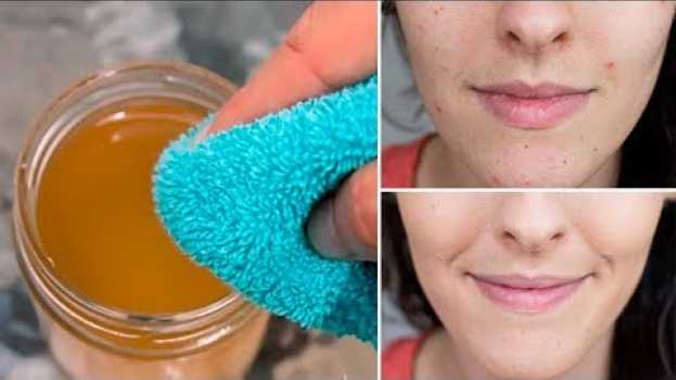 Video Lavati Il Viso Con l'ACETO Di Mele Per 5 Giorni e Guarda Cosa Succede Alla Tua Pelle en français