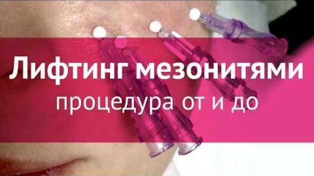 Video Подтяжка лица мезонитями: процедура от и до su italiano