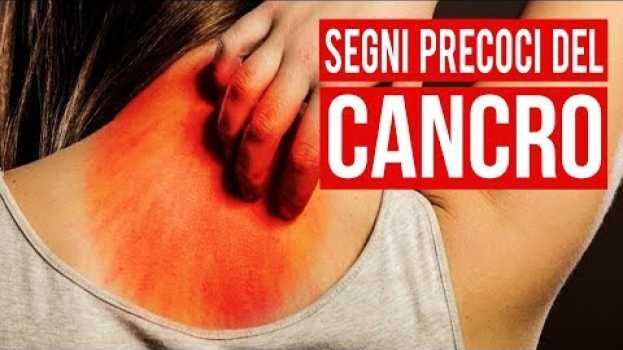 Video 10 Segni Precoci Del Cancro Che La Maggior Parte Delle Persone Ignora en español