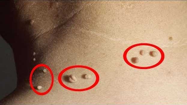 Video Rimedi Casalinghi Rapidi, Facili, Economici Per Liberarsi Dei Fibromi Della Pelle! (Fibromi Penduli) em português