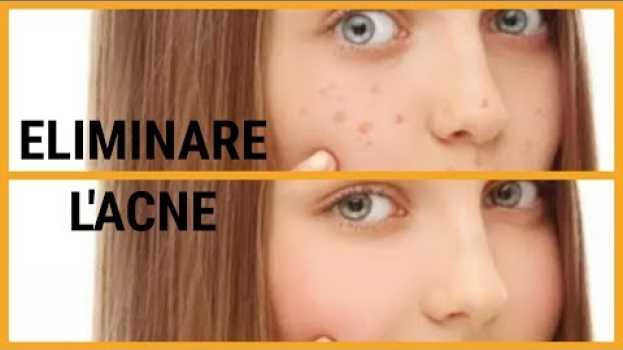 Video ♡ Come ELIMINARE L'ACNE dal viso - Rimedio naturale ♡   türkçe