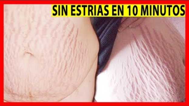 Video Dile Adiós a Las ESTRIAS Con Ese POTENTE Método Natural ➜  Usted Nunca Ha Visto Nada Igual!! in English