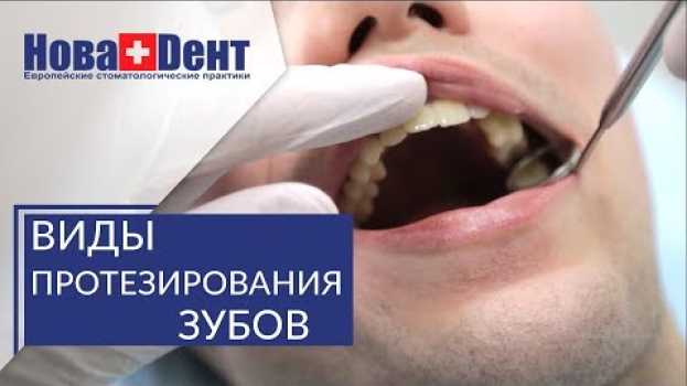 Video Протезирование зубов при полной потере. 🔬 Варианты протезирования при полной потере зубов. НоваДент su italiano