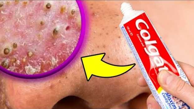Video Como Tirar CRAVOS e ESPINHAS Em 10 MINUTOS ou Menos Sem Gastar Quase Nada ! po polsku