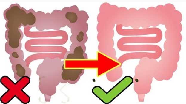 Video Come espellere il materiale fecale dal colon in un solo giorno auf Deutsch