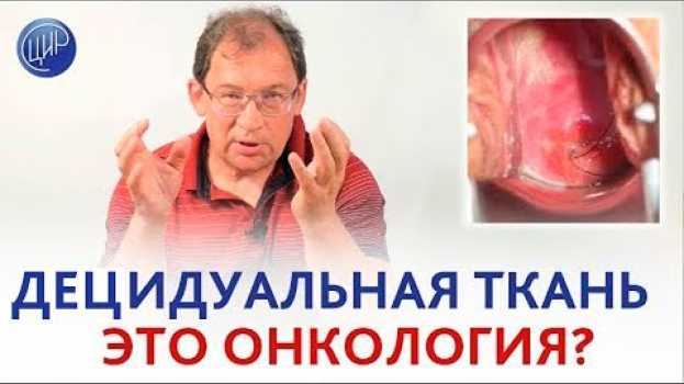 Video ЭТО ОНКОЛОГИЯ? Чистка после замершей беременности: децидуальная ткань и повышен ХГЧ. in English