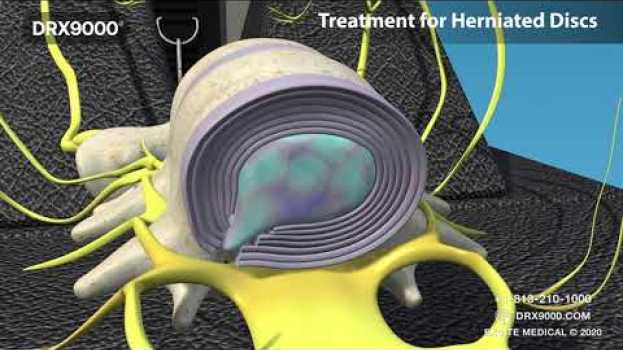 Video What is Spinal Decompression? DRX9000 for low back pain, sciatica and herniated disc. Avoid Surgery. auf Deutsch