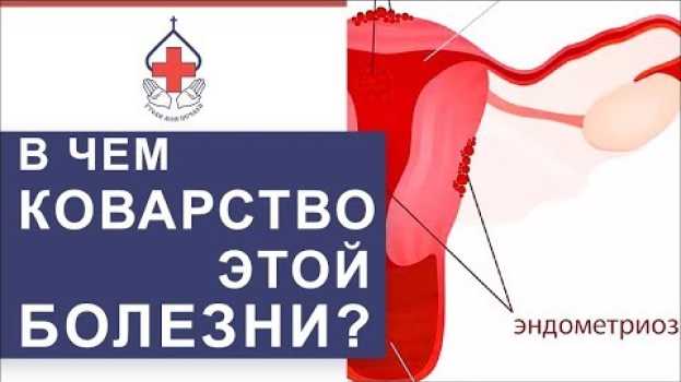 Video 👩 Чем опасен генитальный эндометриоз и как его лечат. Чем опасен эндометриоз. 12+ su italiano
